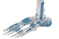 3D-orthopedic-implant-render